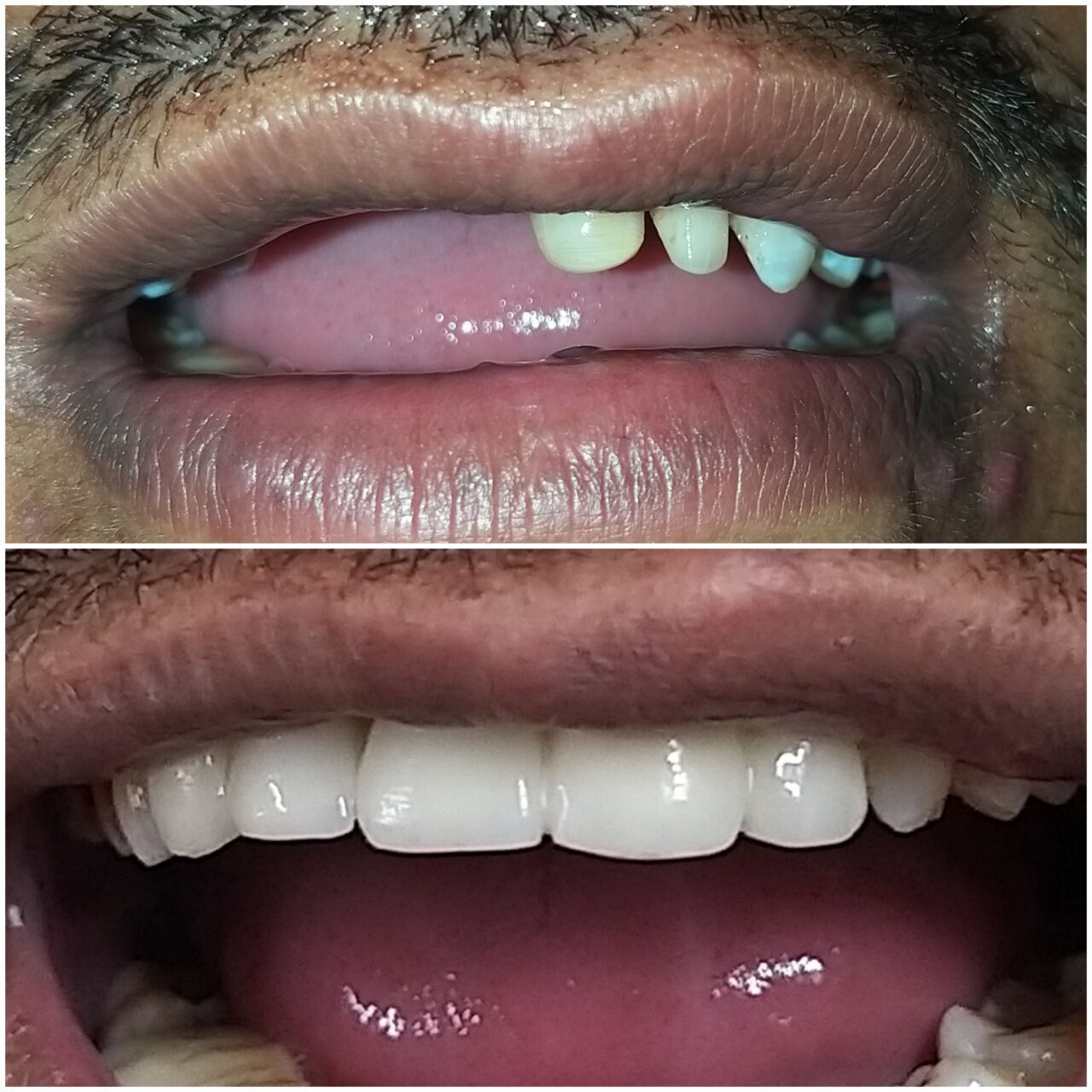 full mouth rehabilitation with ceramic bridge - 1