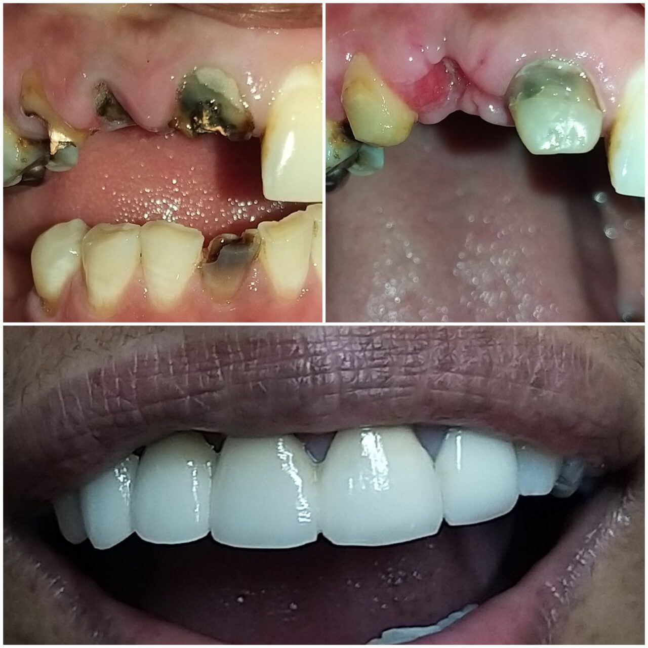 full mouth rehabilitation with ceramic bridge - 3