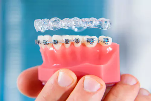 aligners-braces