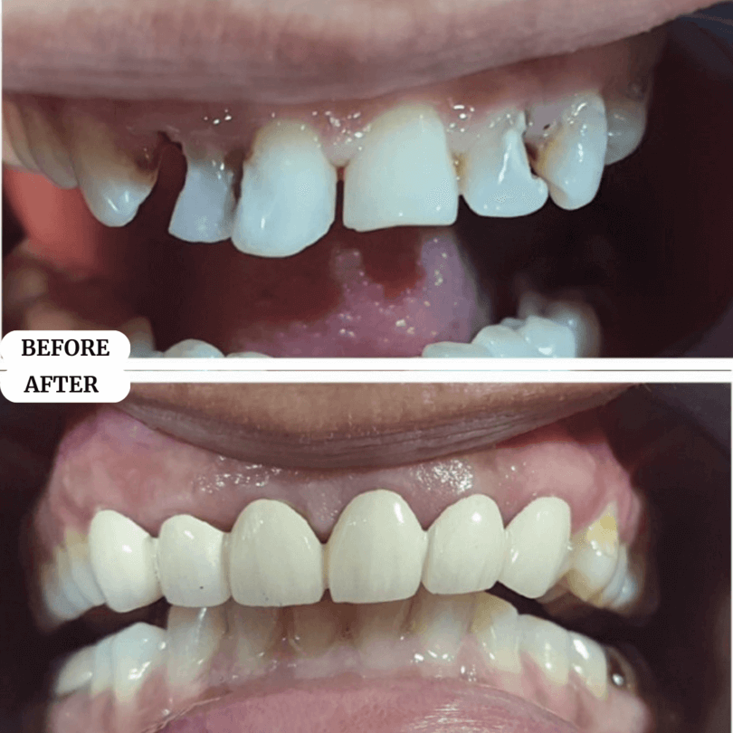 02 perfect smile before after result